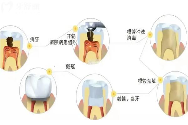 固定義齒過(guò)程圖解說(shuō)明