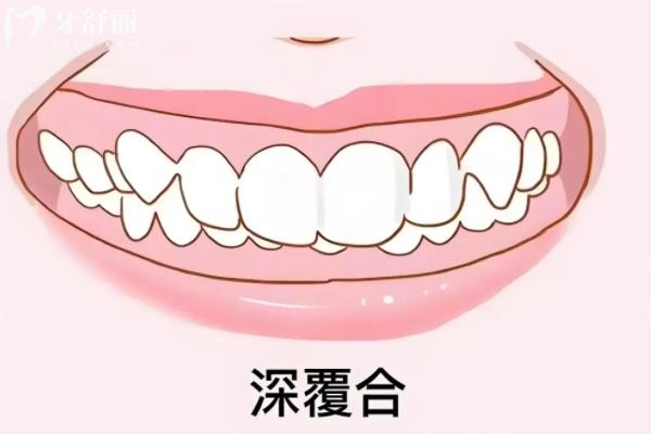 不影響美觀的深覆合還需要矯正嗎