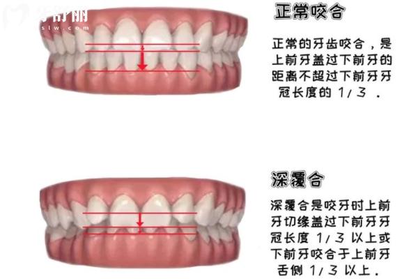 不影響美觀的深覆合還需要矯正嗎