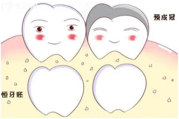 乳牙預成冠作用+分類+適用情況+注意事項  點擊查看