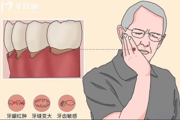 重度牙周炎牙齒松動(dòng)