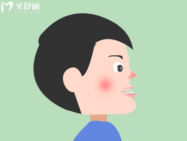 骨性地包天不治療會(huì)有什么后果