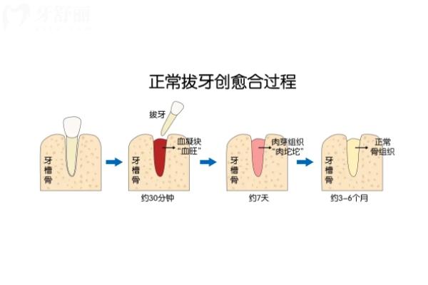 拔完牙后牙窟窿多久能長(zhǎng)好