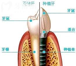種植牙的材料有哪幾種?種植牙材料會(huì)對(duì)身體有影響嗎?