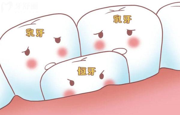 兒童雙層牙齒的成因是什么