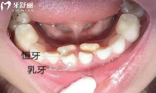 雙層牙不治療會有什么危害