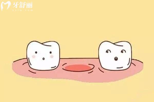 什么是先天性缺牙？先天性缺牙的治療方法