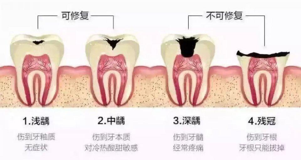 乳牙需要做根管治療嗎？