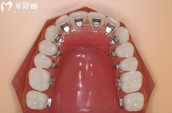 為啥舌側(cè)矯正很少人做？