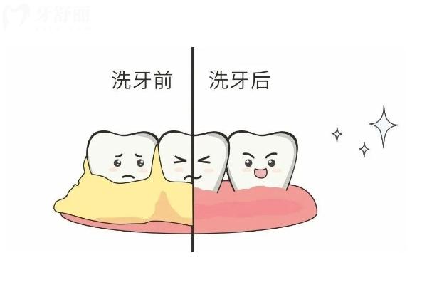 什么是噴砂潔牙？噴砂or超聲波該怎么選？詳細(xì)解析 點(diǎn)擊查看