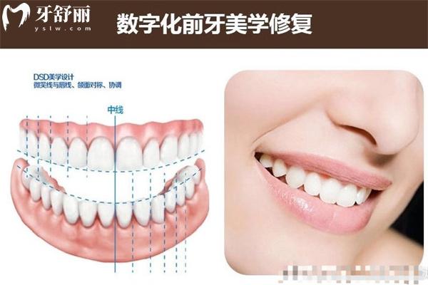 美學(xué)牙齒貼面十大品牌排名已出 國產(chǎn)/進口美學(xué)貼面材質(zhì)價格信息分享