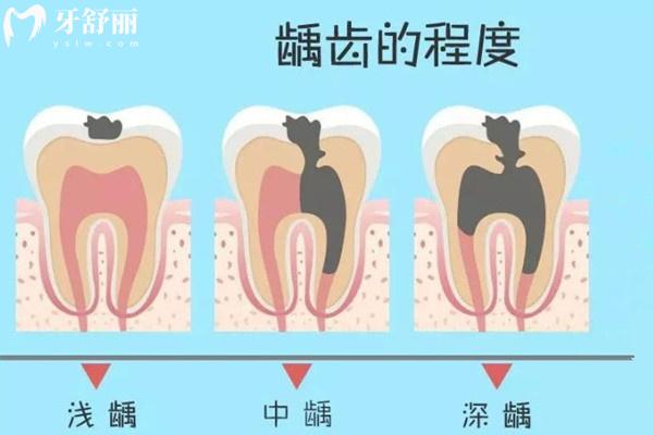 齲齒的發(fā)展過程