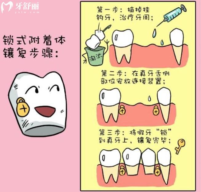無(wú)掛鉤假牙
