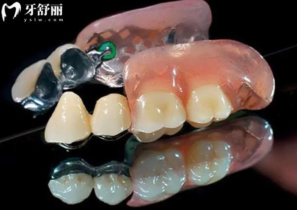 精密附著體義齒