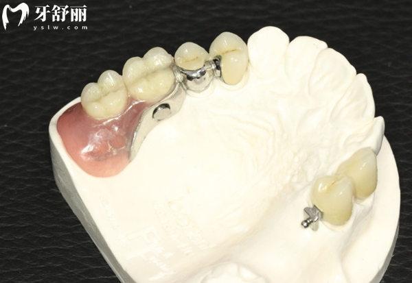 精密附著體義齒優(yōu)點