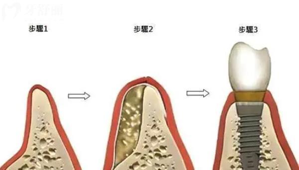 牙槽骨再生手術(shù)
