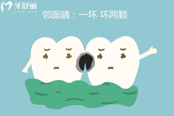 為什么鄰面齲一定要補(bǔ)？鄰面齲一下壞兩個(gè)，要注意！