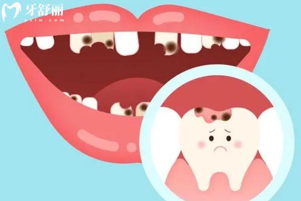 為什么鄰面齲一定要補(bǔ)？鄰面齲一下壞兩個(gè)，要注意！