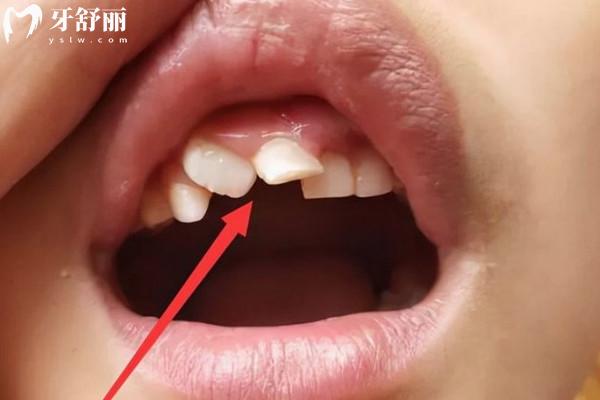 上門牙長歪了怎么辦