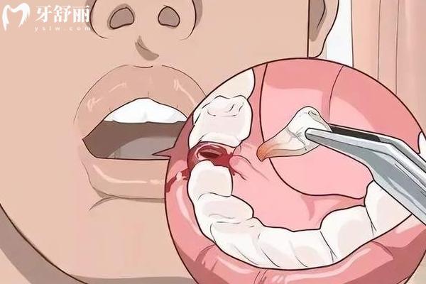 為什么牙疼的時(shí)候不能拔牙？