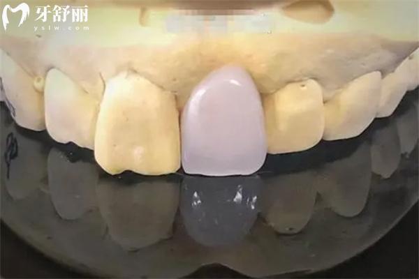 大同牙科醫(yī)院鑲牙冠多少錢