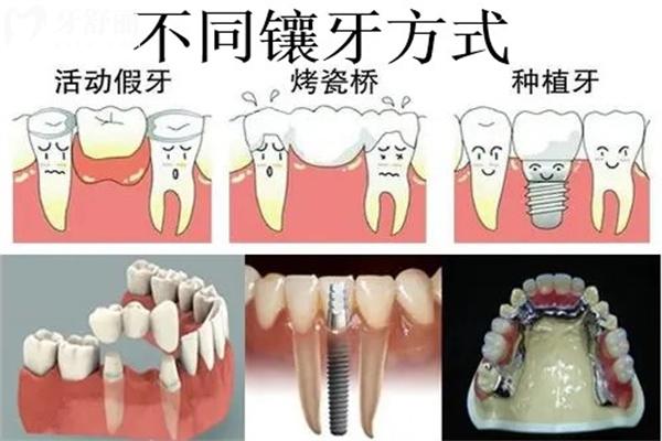 拔牙后的鑲牙方式