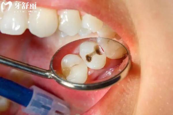 齲齒的類型有哪些？齲齒該如何治療？