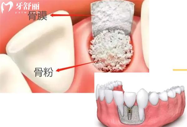 種植牙在什么情況下要用到骨粉和骨膜