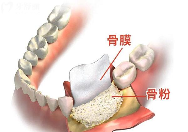 種植牙用的骨粉和骨膜有什么作用？