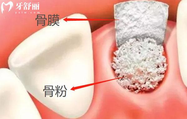 種牙用骨粉骨膜多長(zhǎng)時(shí)間能消腫