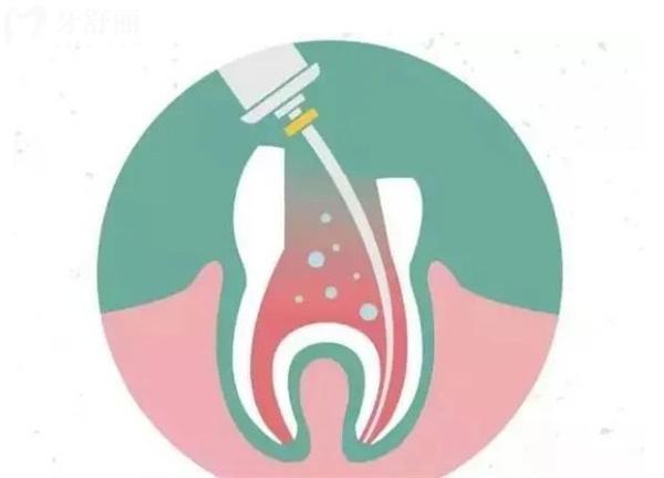 牙齒酸酸的情況治療方法