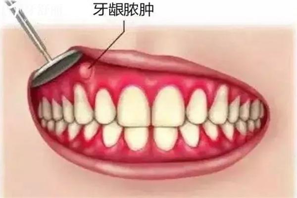 牙齦一吸就出血是怎么回事?