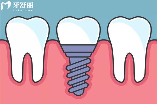 種植牙國(guó)產(chǎn)的好還是進(jìn)口的好