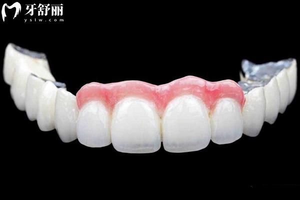 愛爾創(chuàng)全瓷牙冠質(zhì)保幾年