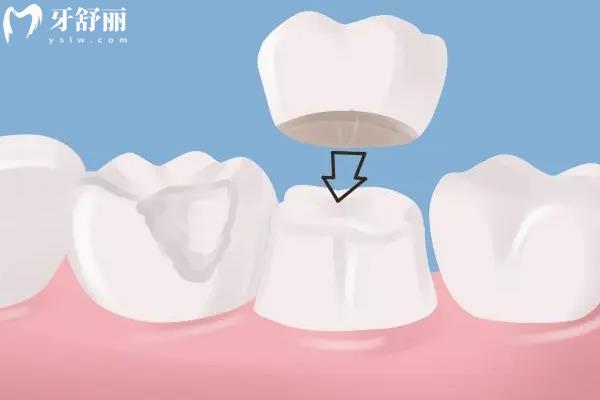 殺神經(jīng)和根管治療是一回事嗎？