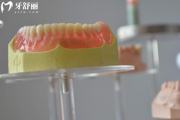 上海裝活動(dòng)假牙多少錢