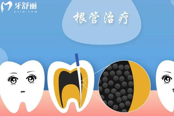 根管治療為啥前牙和后牙的價格不一樣？