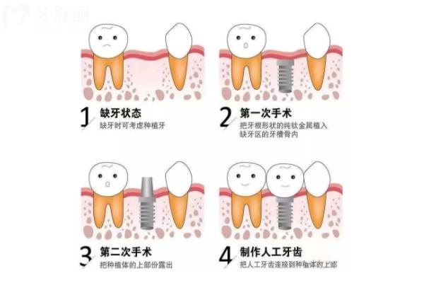20多歲種植牙好還是做冠好？