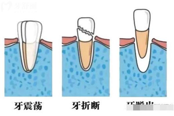 牙外傷常見的類型有哪些