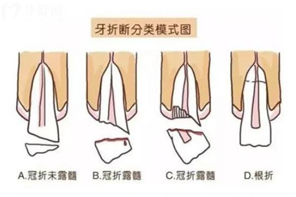 牙外傷常見的類型有哪些
