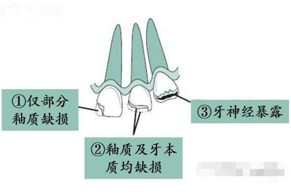 牙外傷常見的類型有哪些