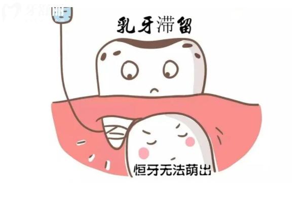 乳牙是拔掉還是自然脫落好