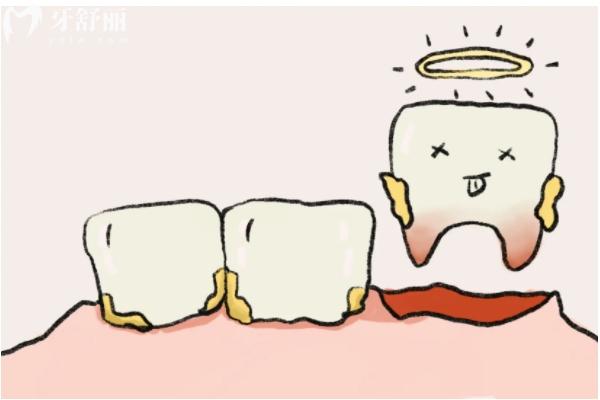 先洗牙還是先拔牙補(bǔ)牙？