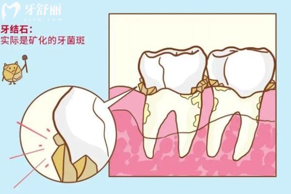 先洗牙還是先拔牙補(bǔ)牙？