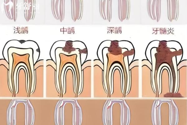 先洗牙還是先拔牙補(bǔ)牙？