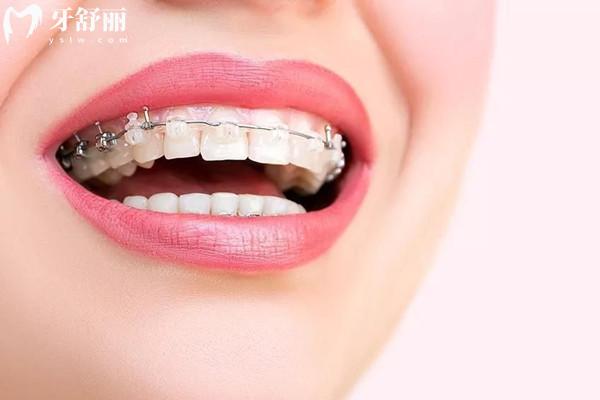 15歲矯正牙齒的利弊是什么