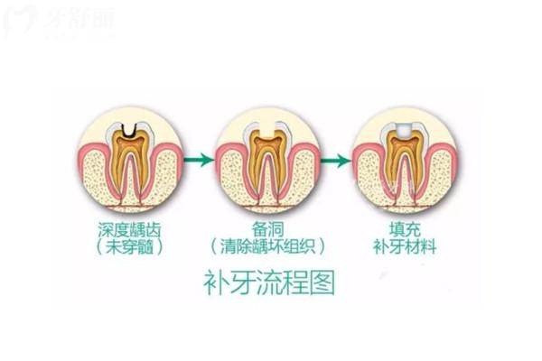 十歲孩子補牙，長大后還需要補嗎