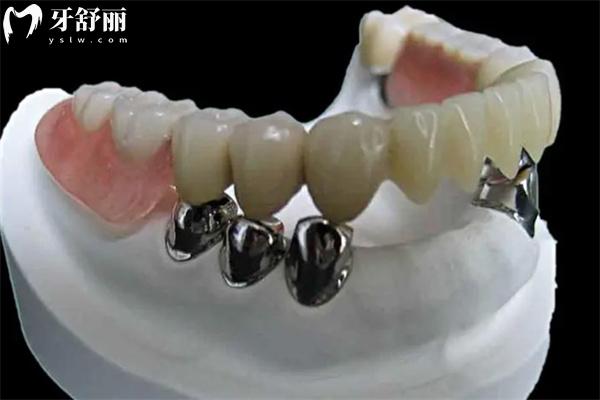 老年人牙齒掉光了裝什么假牙合適?價格一般多少錢？