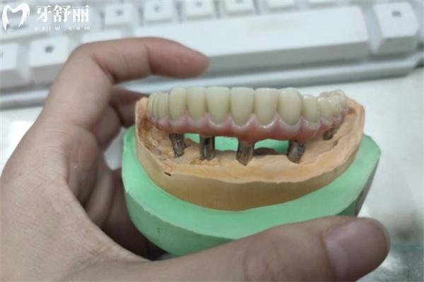 老年人牙齒掉光了裝什么假牙合適?價格一般多少錢？