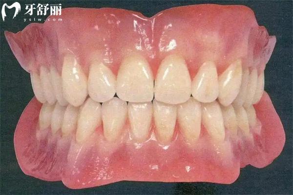 國內(nèi)常用全口義齒種類有哪些？大概多少錢一副？